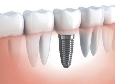 Implanti - Način da nadoknadite izgubljeni zub