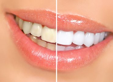 Zašto zubi menjaju svoju boju?
