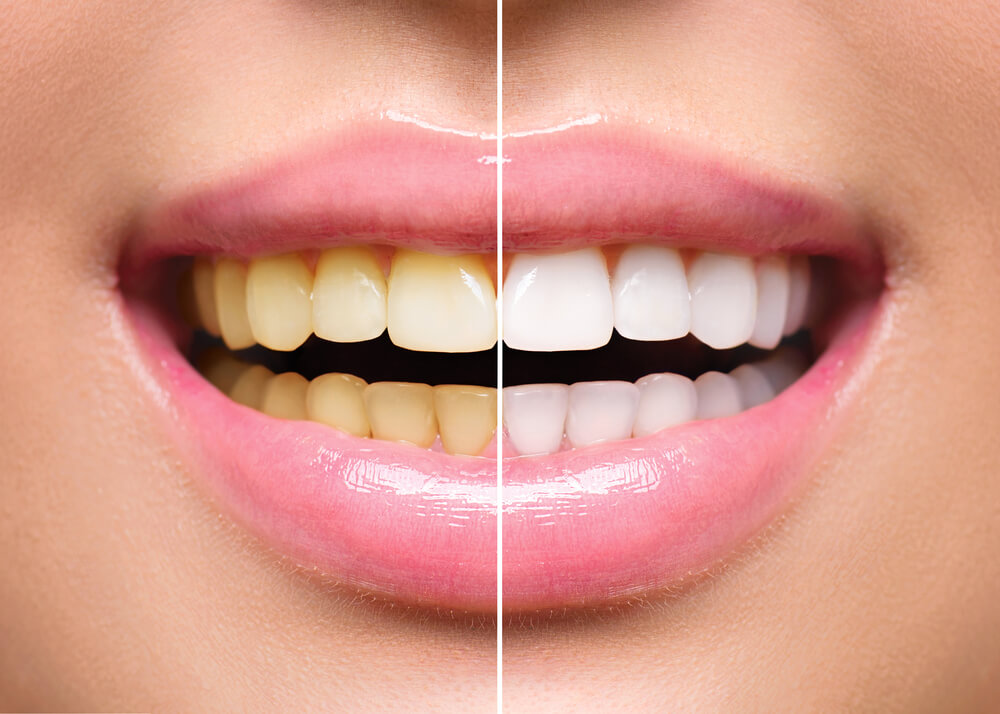 Pigmentacija na zubima 