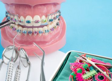Damon sistem - Ispravljanje nepravilnog položaja zuba