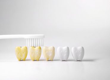 Zubni kamenac - Kako nastaje i koje probleme može prouzrokovati