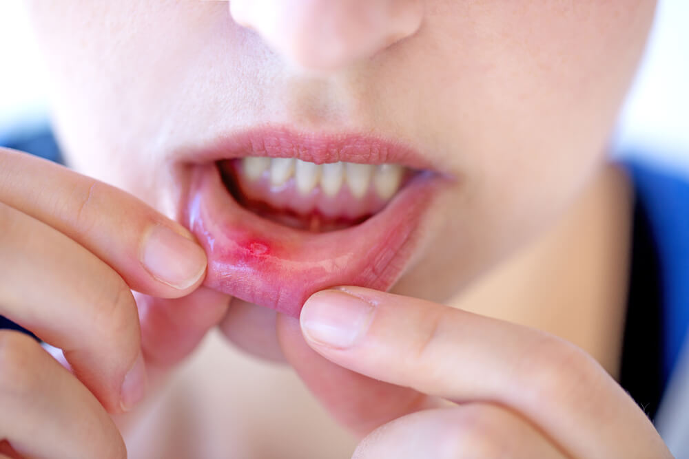Oboljenja mekih tkiva usne duplje