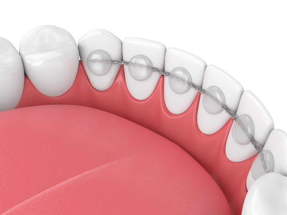 Ortodontska retencija 
