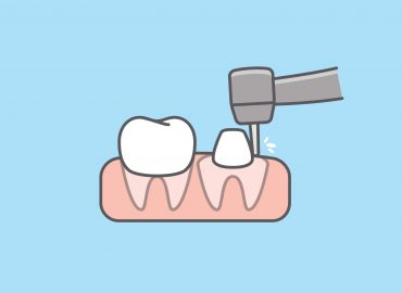 Brušenje zuba - Koji su razlozi za preparaciju zuba?