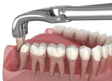 Alveotomija - Hirurško vađenje zuba