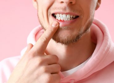 Razumevanje različitih faza bolesti desni