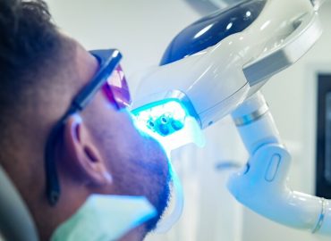 Koji su najčešći razlozi za beljenje zuba?