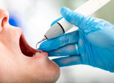 Zašto je važno skidanje zubnog kamenca - Zdravstvene posledice i prevencija